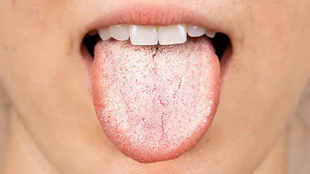 जिब्रोमा सेतो तह किन बन्छ ? के यो कुनै रोगको संकेत हो ?